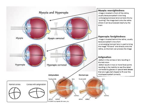 Image result for Myopia Hyperopia