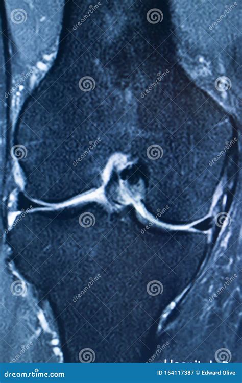 Knee injury mri mcl tear stock image. Image of resonance - 154117387