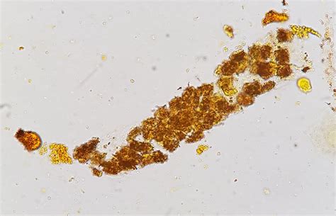 Bilirubin Crystals In Urine