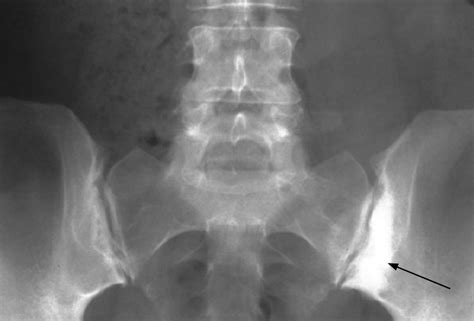 Sacroiliac Joint Xray