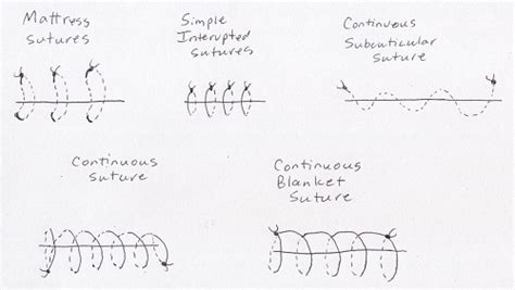 Image result for Simple Continuous Suture Removal