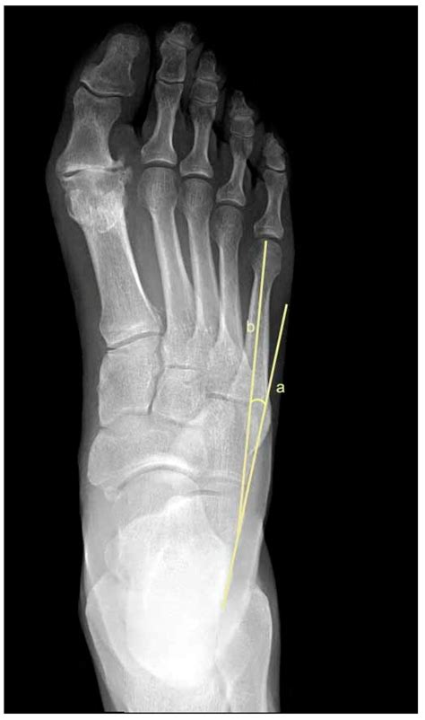 Intra and Inter-Observer Reliability and Repeatability of Metatarsus ...