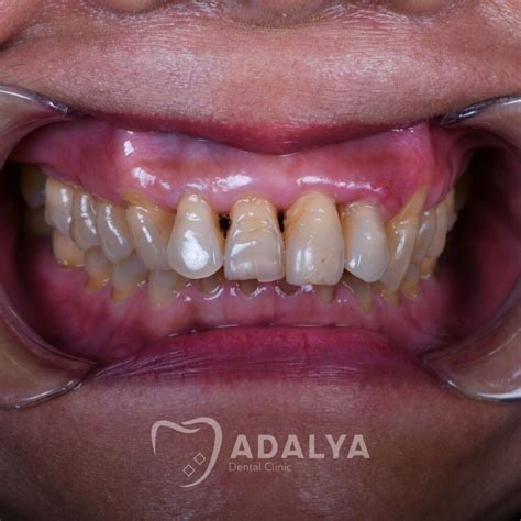 Receding Gum Line Causes - How to Fix Receding Gums