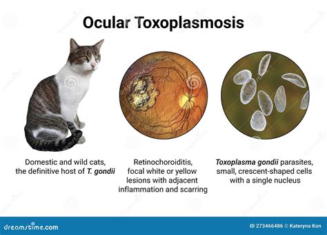 Ocular Toxoplasmosis, Retinal Scar Caused by a Toxoplasma Gondii ...