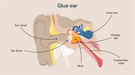 Glue ear