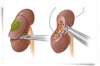 Image result for Steps of Partial Nephrectomy