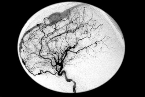What Is Dural Av Fistula at Melanie Boomer blog