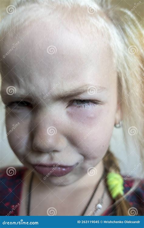 Little Upset Girl with a Bite Under the Eye Stock Image - Image of little, angry: 263119045