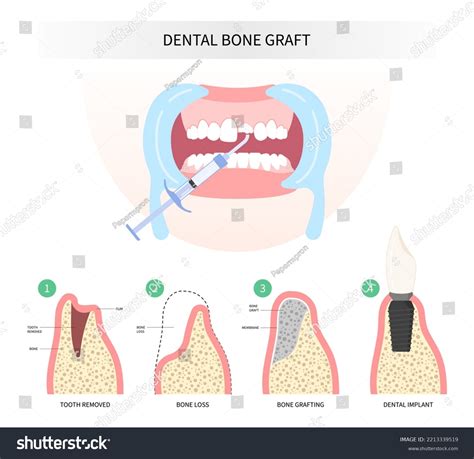 Tooth Decay Medical Procedure