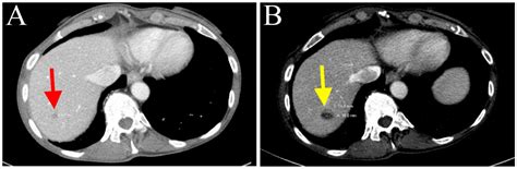 Nab-Paclitaxel and Gemcitabine as First-Line Treatment of Metastatic ...
