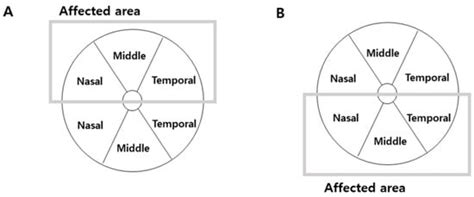 Changes in Neurodegeneration and Visual Prognosis in Branch Retinal ...