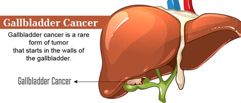 Image result for Gallbladder Cancer