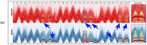 Identifying Patterns for Neurological Disabilities by Integrating ...