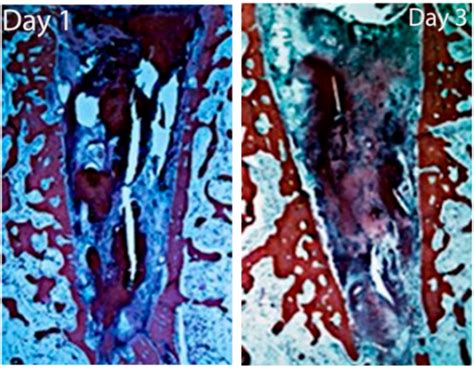 Image result for Tooth Extraction Scar Tissue