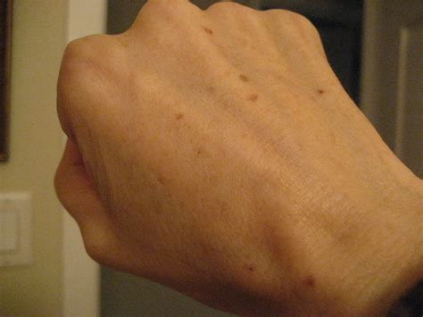Chemical Peels for Acne and Anti Aging: Hand Age Spots Treated with TCA Peel: Days 1-10