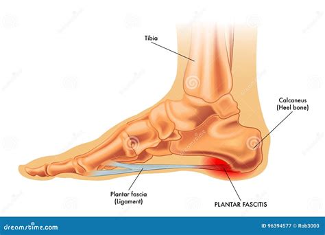 Symptoms of Plantar Fasciitis Stock Vector - Illustration of sinew, symptom: 96394577