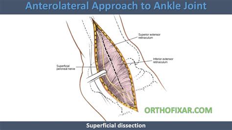 Image result for Ankle Anterolateral Approach Injection