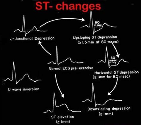 Image result for St Modifier Examples