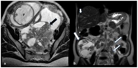 Manifestations of Ovarian Cancer in Relation to Other Pelvic Diseases by MRI