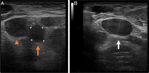 Kikuchi disease: An alternative diagnosis in patients with axillary ...