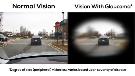 Glaucoma - Cates Family Eye Care