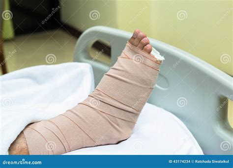 Patient with Broken Leg in Cast and Bandage Stock Photo - Image of ...