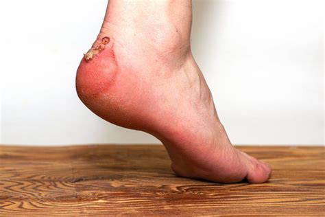 How To Stop Shoes From Rubbing The Back Of Your Ankle? - HoodMWR