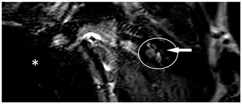 Endolymphatic Hydrops Magnet Resonance Imaging in Ménière’s Disease ...