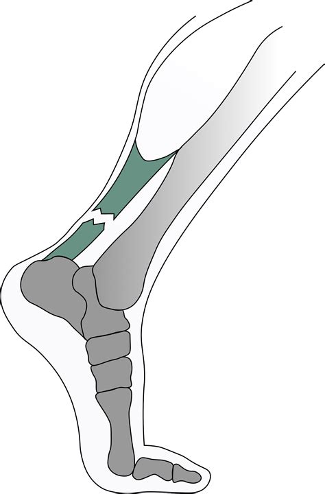 Torn Achilles Recovery Guide: Boot vs Cast, Surgery Timeline & Sleeping Tips