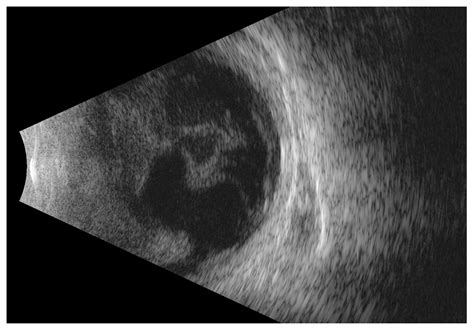 Sudden Vision Loss as the First Sign of Sepsis—Bilateral Endogenous ...
