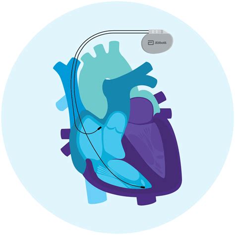Pacemakers for Heart Arrhythmias | Abbott