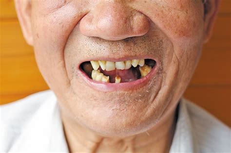 老年人不可以做种植牙吗？|身体条件|种植牙|老年人|手术|牙齿|掉牙|-健康界