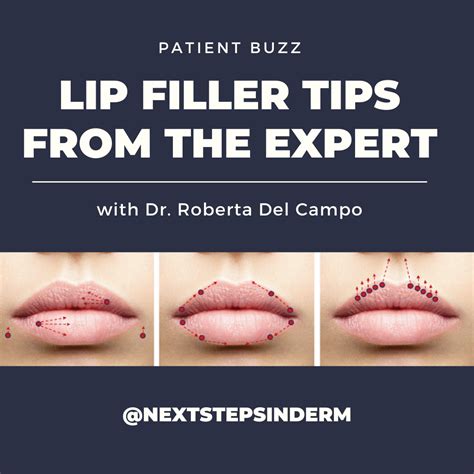Patient Buzz: Lip Filler Tips From the Expert - Next Steps in ...