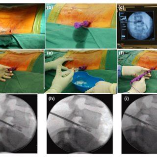 Image result for Disc FX Procedure