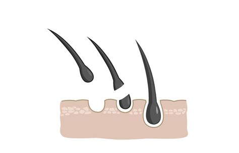 Addressing Underlying Medical Conditions Causing Hair Loss – myUpchar ...