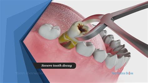 Image result for Getting Tooth Removed