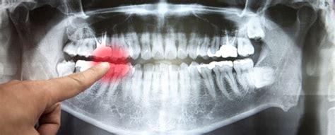 Scientists Found an Unexpected Sign of Human Longevity—Our Teeth