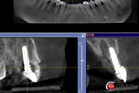 數位式模擬植牙 減少手術併發症 - 自由健康網