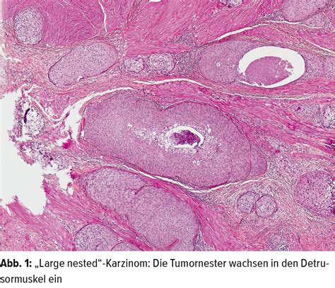 Neue Konzepte in der Blasenpathologie - Pathologie - Universimed ...