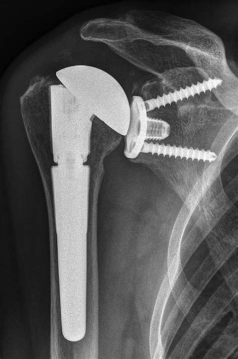 The use of a modular system to convert an anatomical total shoulder arthroplasty to a reverse ...