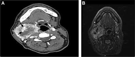 Midline mandibulotomy for large carotid body tumors: A valuable approach - Journal of Vascular ...
