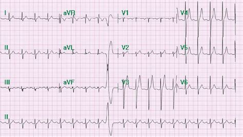 Image result for AFib Detection Algorithm