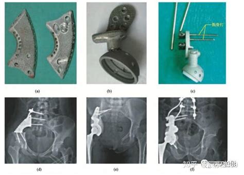 3D 打印钛金属骨科植入物应用现状 - 知乎