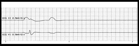 Asystole ACLS Algorithm 的图像结果