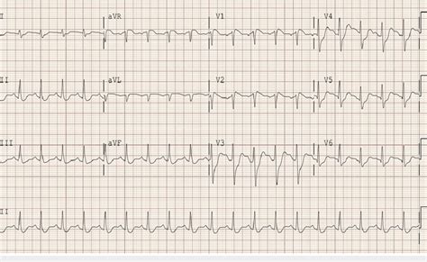 Image result for AFib Detection Algorithm