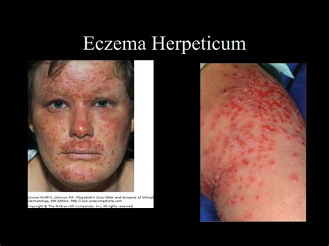 PPT - Dermatologic Emergencies PowerPoint Presentation, free download ...