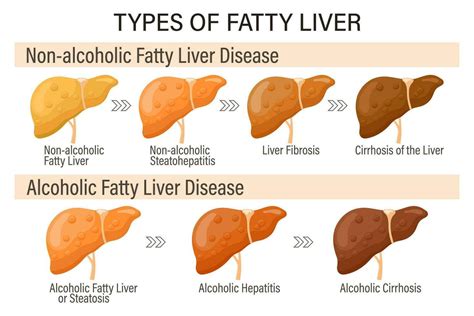 The Importance of the Liver: Managing Fatty Liver and Effective Detox ...