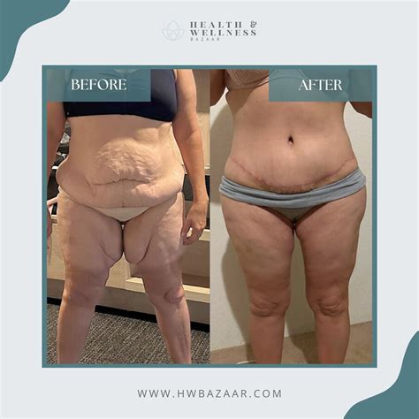 Skin Removal Surgery In Tijuana | Post–Weight Loss Experts