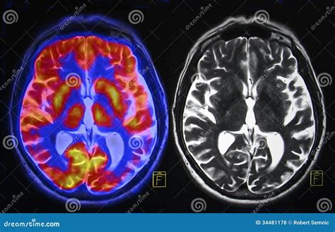 脑部扫描 库存照片. 图片 包括有 上色, 黄色, 区域, 照片, 重点, 查出, 翻译, 红色, 程序 - 34481178