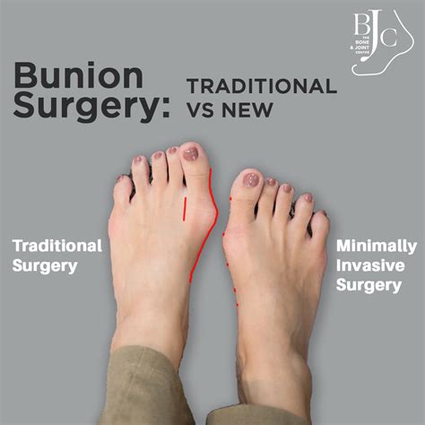 Types Of Bunion Operations